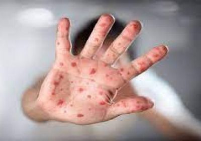 سويسرا تسجل أول إصابة بجدري القردة