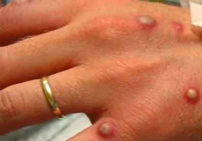 النمسا تسجل أول إصابة بمرض جدري القردة