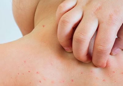 الدنمارك ترصد أول إصابة بجدري القرود