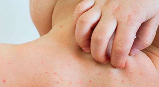 الدنمارك ترصد أول إصابة بجدري القرود