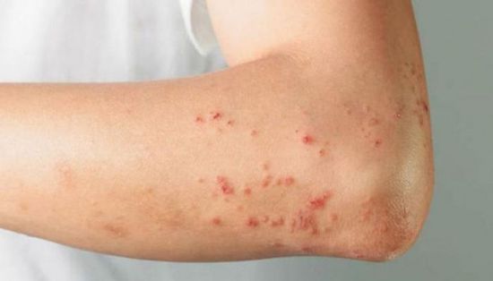 وكالة الصحة الأوروبي: تفشي جدري القرود ضعيف للغاية