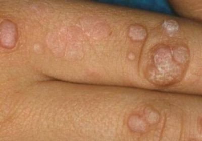 سلطنة عُمان تؤكد عدم رصد أي إصابة بمرض جدري القرود