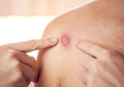 الصحة العالمية: تسجيل 131 إصابة مؤكدة بجدري القرود في 19 دولة