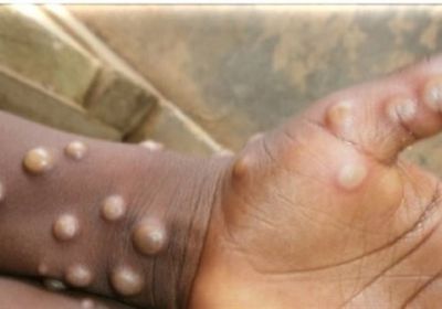 قبل نهائي دوري أبطال إفريقيا.. المغرب تعلن ظهور 3 حالات يشتبه في إصابتها بجدري القرود