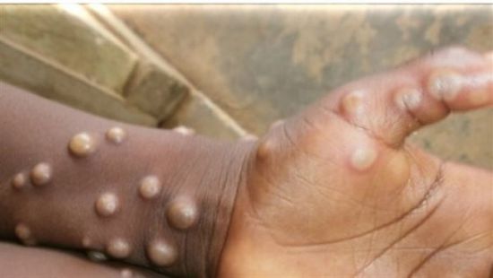 قبل نهائي دوري أبطال إفريقيا.. المغرب تعلن ظهور 3 حالات يشتبه في إصابتها بجدري القرود