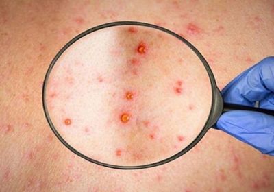 ارتفاع حالات الإصابة بجدري القردة في فرنسا