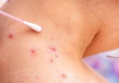 الكشف عن أول إصابة بجدري القرود في أيرلندا