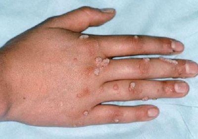 تسجيل 3 إصابات جديدة بجدري القردة في الإمارات