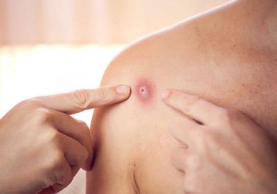 الصحة العالمية تكشف توقعاتها بشأن جدري القردة