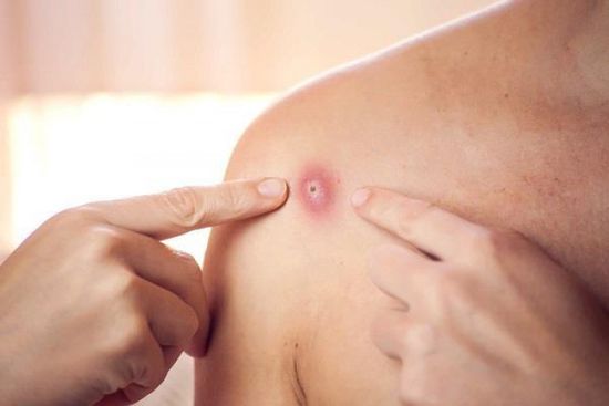 الصحة العالمية تكشف توقعاتها بشأن جدري القردة