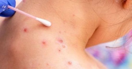 رصد 77 حالة جدرى قرود فى كندا