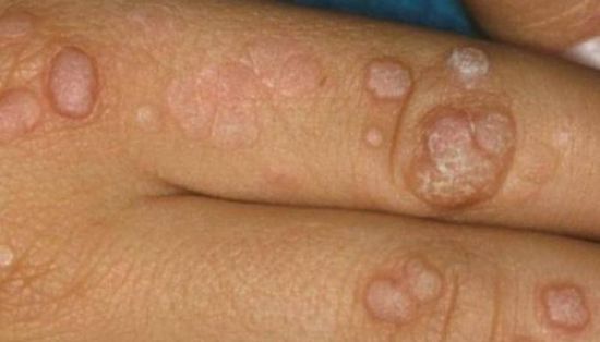 تسجيل 43 إصابة جديدة بجدري القرود في إنجلترا