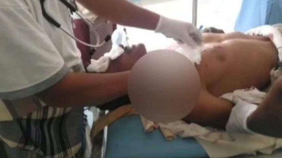 جرح مزارع جراء انفجار لغم في حراثته بحيس