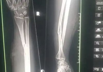 إصابة فتاة شمال الضالع بعيارين لقناص حوثي