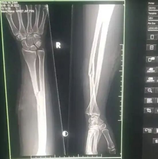 إصابة فتاة شمال الضالع بعيارين لقناص حوثي