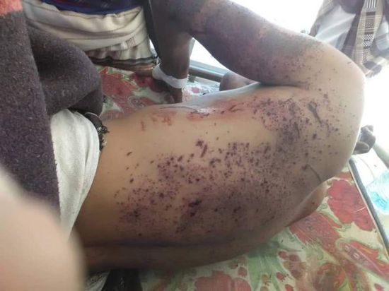 شهيد وجريحان في تفجيرين استهدفا القوات الجنوبية بمودية