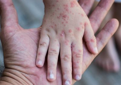 مليشيا الحوثي تنشر الحصبة بـ26 ألف إصابة خلال 6 أشهر 