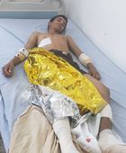 انفجار مقذوف من مخلفات الحوثي في 3 أطفال شمال الضالع