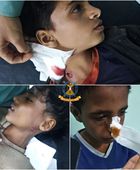 الواقعة الثانية بأسبوع.. انفجار مقذوف حوثي في 3 أطفال شمال الضالع