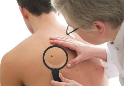 تشخيص سرطان الجلد أصبح أسرع بفضل الابتكارات