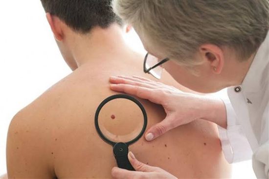 تشخيص سرطان الجلد أصبح أسرع بفضل الابتكارات