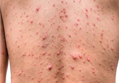 تايلاند: اكتشاف إصابة أجنبي وافد من أفريقيا بجدري القردة