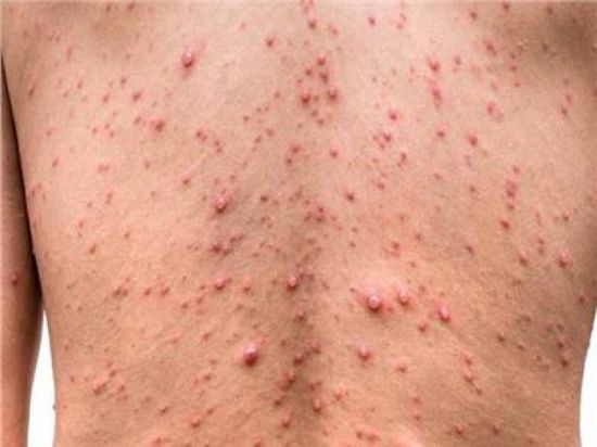 تايلاند: اكتشاف إصابة أجنبي وافد من أفريقيا بجدري القردة