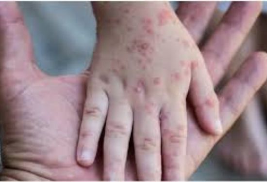 الهند: تسجيل حالة إصابة بجدري القردة لدى مسافر قادم من دولة تشهد تفشيا