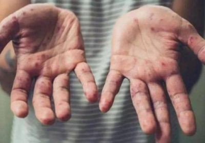 منظمة الصحة العالمية: جدري القردة ما زال حالة طوارئ صحية