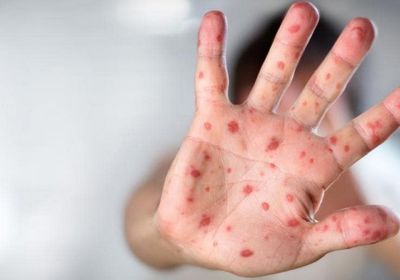 تفشٍ جديد لمرض الحصبة في 6 ولايات أمريكية