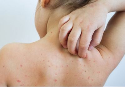 597 حالة.. الحصبة تتفشى في ولاية تكساس