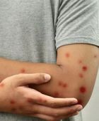 إصابات الحصبة تتخطى الألف حالة بأمريكا