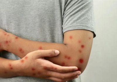 إصابات الحصبة تتخطى الألف حالة بأمريكا