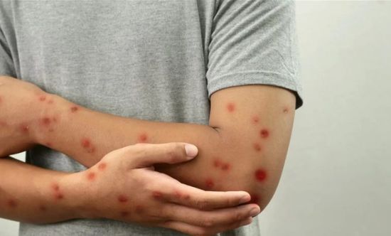 إصابات الحصبة تتخطى الألف حالة بأمريكا