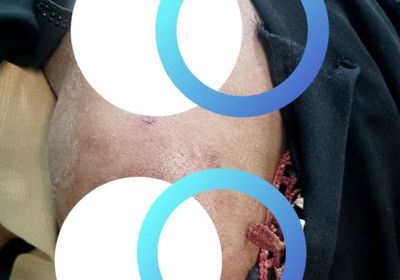 قناص حوثي يستهدف امرأة بعيار ناري شمال الضالع