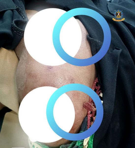 قناص حوثي يستهدف امرأة بعيار ناري شمال الضالع