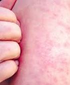 تكساس الأمريكية تسجل 4 إصابات جديدة بالحصبة