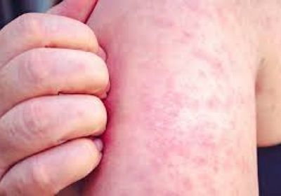 تكساس الأمريكية تسجل 4 إصابات جديدة بالحصبة