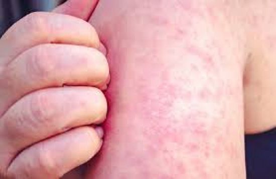 تكساس الأمريكية تسجل 4 إصابات جديدة بالحصبة