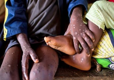 غينيا: تسجل 49 إصابة جديدة بمرض جدري القرود