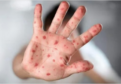 تايلاند: رصد 40 إصابة بجدري القرود في 2025