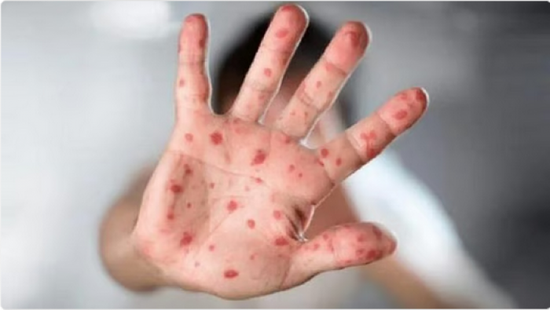 تايلاند: رصد 40 إصابة بجدري القرود في 2025