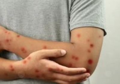 غينيا تعلن حالة طوارئ صحية بعد ارتفاع إصابات جدري القردة إلى أكثر من 300 حالة