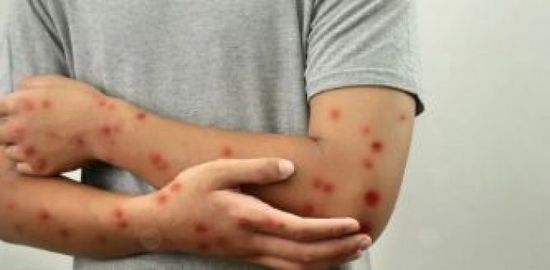 غينيا تعلن حالة طوارئ صحية بعد ارتفاع إصابات جدري القردة إلى أكثر من 300 حالة