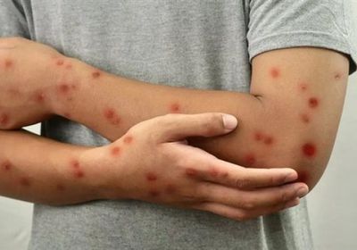 زيادة إصابات الحصبة في الأمريكيتين