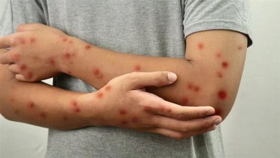 زيادة إصابات الحصبة في الأمريكيتين