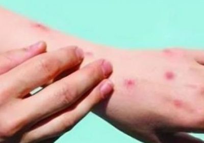 غانا تسجّل 22 إصابة جديدة بجدري القرود والوفيات ترتفع إلى حالة واحدة