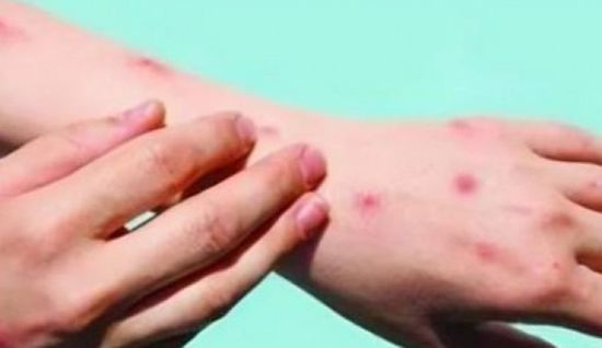 غانا تسجّل 22 إصابة جديدة بجدري القرود والوفيات ترتفع إلى حالة واحدة