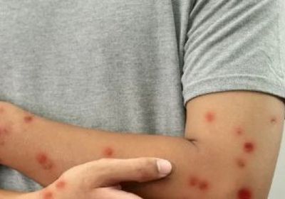 مدير منظمة الصحة العالمية: جدري القردة لم يعد حالة طوارئ دولية