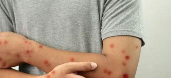 مدير منظمة الصحة العالمية: جدري القردة لم يعد حالة طوارئ دولية